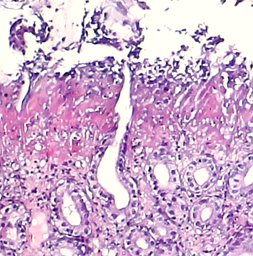 Erosive Gastritis